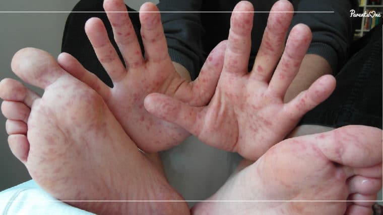 NEWS: โรคมือ เท้า ปาก ระบาดอีกครั้ง พบเด็กป่วยแล้วกว่า 11,000 ราย