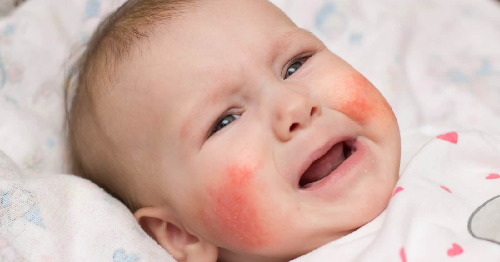 7 Skin Problems In Kids ผื่นภูมิแพ้ผิวหนัง Parents One