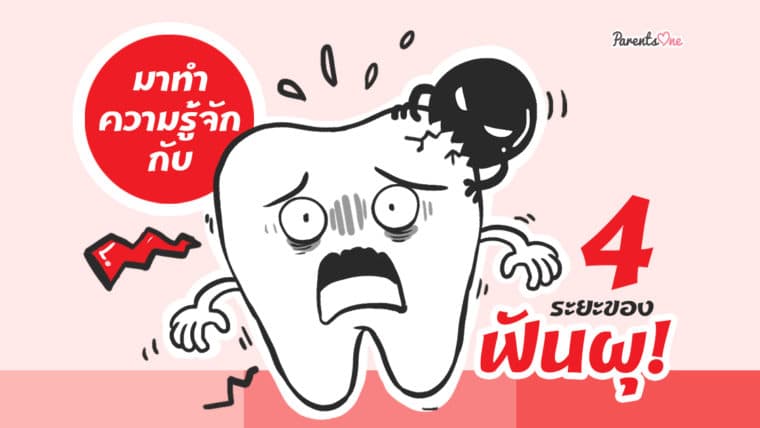 มาทำความรู้จักกับ  4 ระยะของฟันผุ