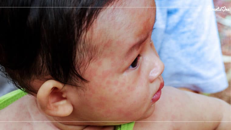 NEWS: อย่าลืมพาลูกไปฉีดวัคซีน ป้องกันโรคหัดและโรคในเด็กอื่นๆ