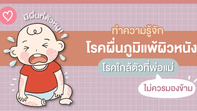 มีผื่นที่ตัวหนู! ทำความรู้จักโรคผื่นภูมิแพ้ผิวหนัง โรคใกล้ตัวที่พ่อแม่ไม่ควรมองข้าม