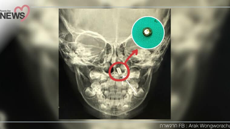 NEWS: อุทาหรณ์พ่อแม่ พบแบตนาฬิกาแบบกลม อยู่ในรูจมูกเด็ก 3 ขวบ
