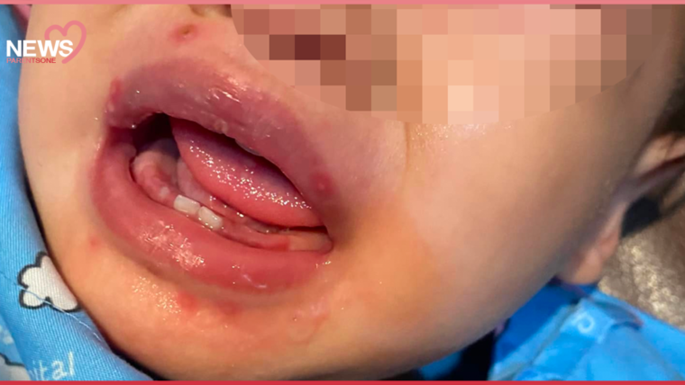 NEWS : อุทาหรณ์! ระวังลูกเป็น “แผลร้อนใน” ในช่องปาก โรคติดต่อจากการเอาสิ่งของเข้าปากแบบไม่รู้ตัว!