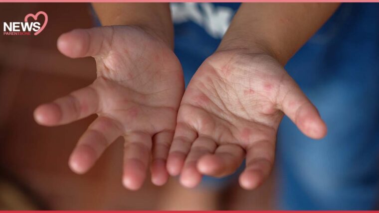 NEWS: พ่อแม่ต้องระวัง โรคมือเท้าปากระบาด โดยเฉพาะในเด็กเล็ก 1-3 ขวบ 