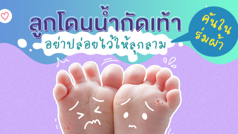 ลูกโดนน้ำกัดเท้า คันในร่มผ้า อย่าปล่อยไว้ให้ลุกลาม