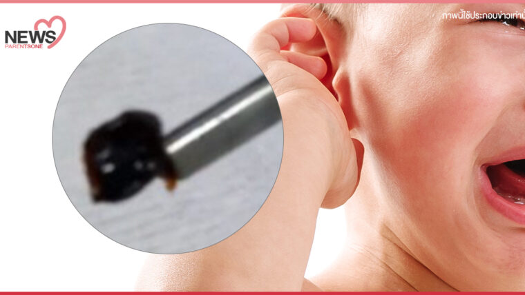 NEWS : เตือนผู้ปกครอง ระวังเศษสำลีหลุดค้างในหูลูก หลังพบเด็กมีอาการเจ็บหู อาจเกิดอันตราย